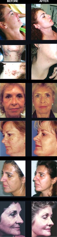 mons veneris liposuction in el paso